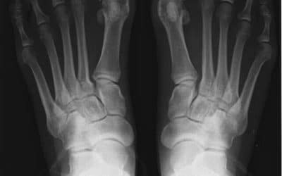How to deal with Hallux Valgus (Bunions)