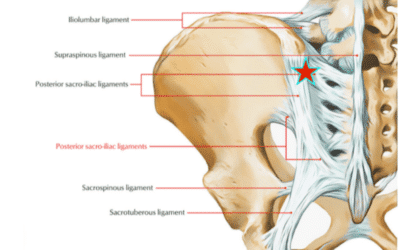 BACK PAIN – IS IT COMING FROM MY SACROILIAC JOINTS?
